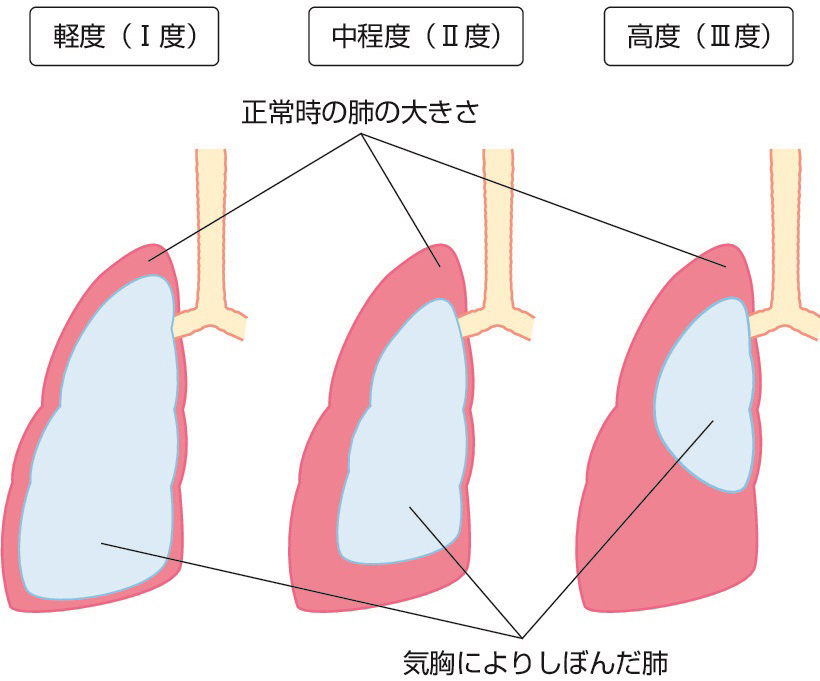 図1　気胸の重症度による分類． 