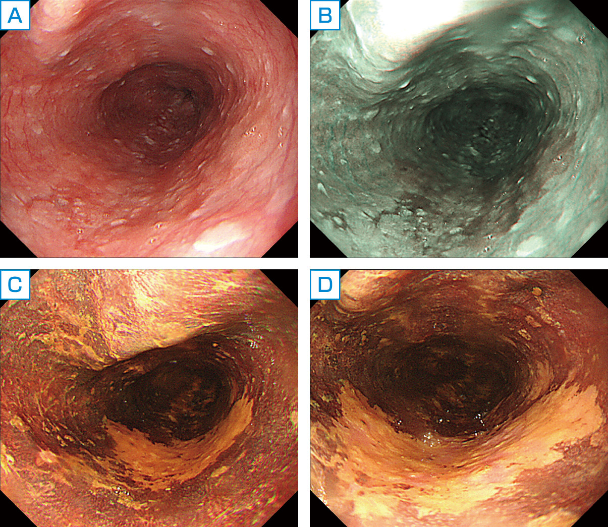 図1　ルゴールによる色素内視鏡画像． A：食道中部の通常観察．後壁中心に不整な発赤帯を認める． B：NBI (narrow band imaging) 併用観察．通常観察における発赤帯がbrownish areaとして認識できる． C：ルゴール散布による色素内視鏡 (染色法) 観察 (chromoendoscopy, staining method) NBIでbrownish areaとして観察された部分に一致して不染帯を認める． D：不染帯の近接観察．不染帯の一部にpink color sign (不染帯の口側) が認められ，内視鏡的に食道表在癌 (0–Ⅱc型) と診断した．