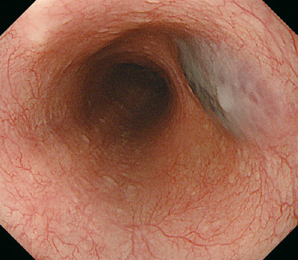 図1　血管腫． 青色調の扁平隆起，脱気すると粘膜下腫瘍様の形態．