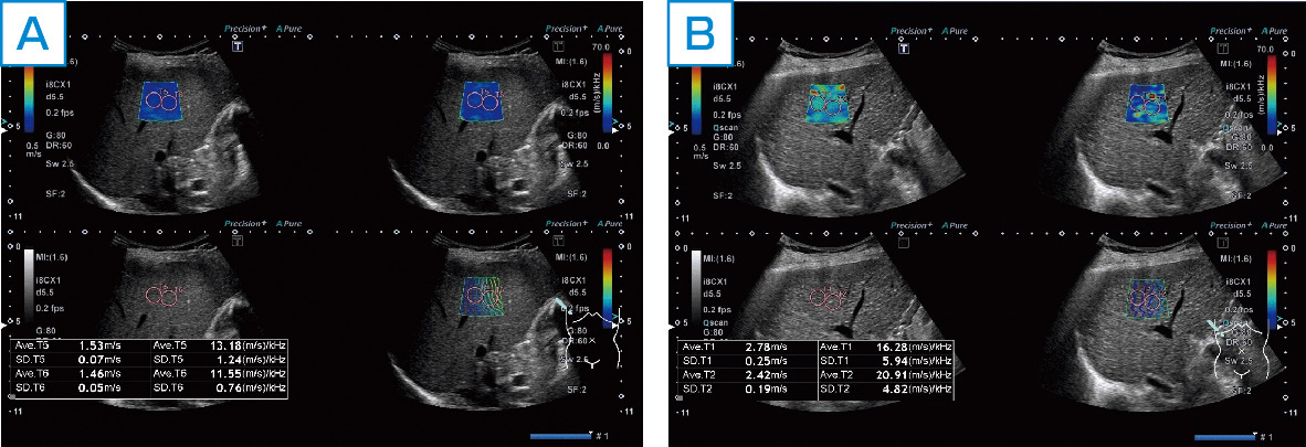 図1　2D shear wave法による肝硬度測定． A：C型慢性肝炎，B：肝硬変．