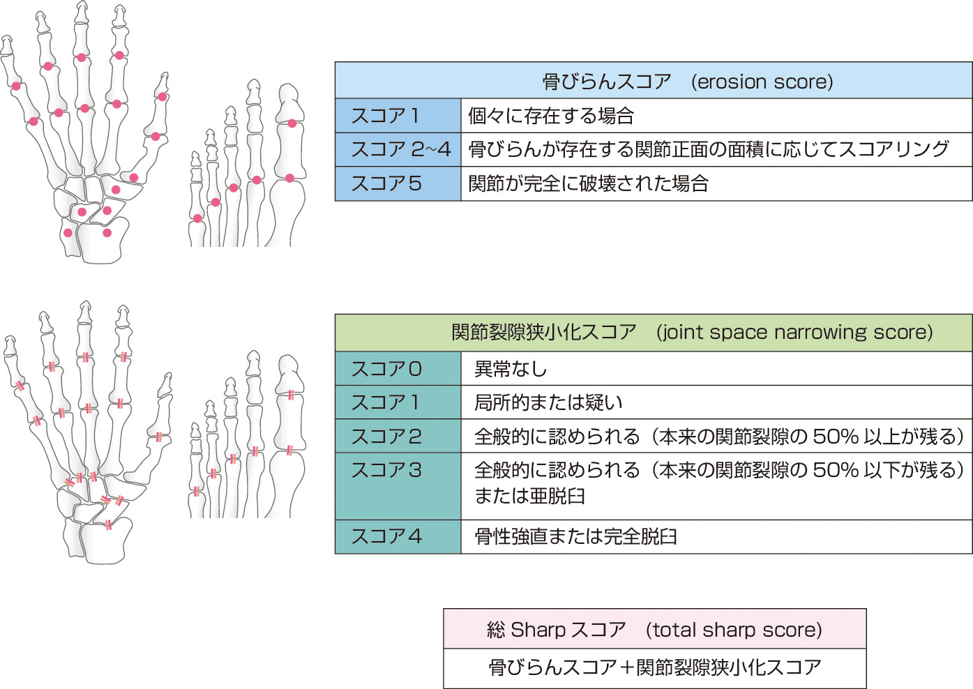 図2　Sharp法による画像評価 (van der Heijde: Baillieres Clin Rheumatol, 1996; 10: 435–453より作成)． 1971年にSharp らにより提唱されたSharp法は，両手正面X線画像での骨びらんと関節裂隙狭小化のスコアから関節を評価する方法である．現在，足正面X線画像を評価対象として加えたvan der Heidjeによるmodified Sharp法が汎用されている．薬剤の開発臨床試験などでは骨関節破壊防止効果判定基準として汎用されている．