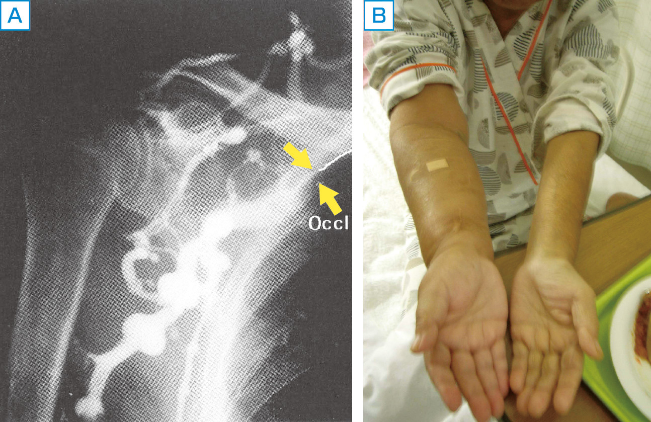 図10　鎖骨下静脈狭窄． 