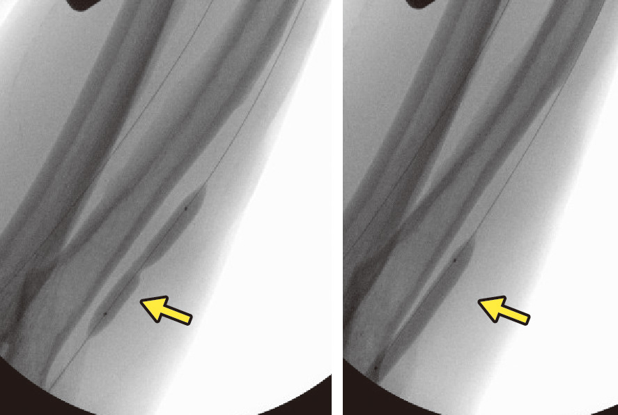 図11　VAIVT (vascular access interventional therapy)． 