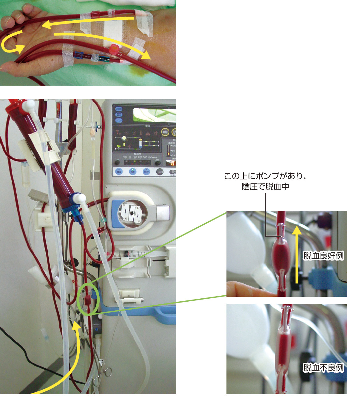 図3　透析回路 (ピロー)． 