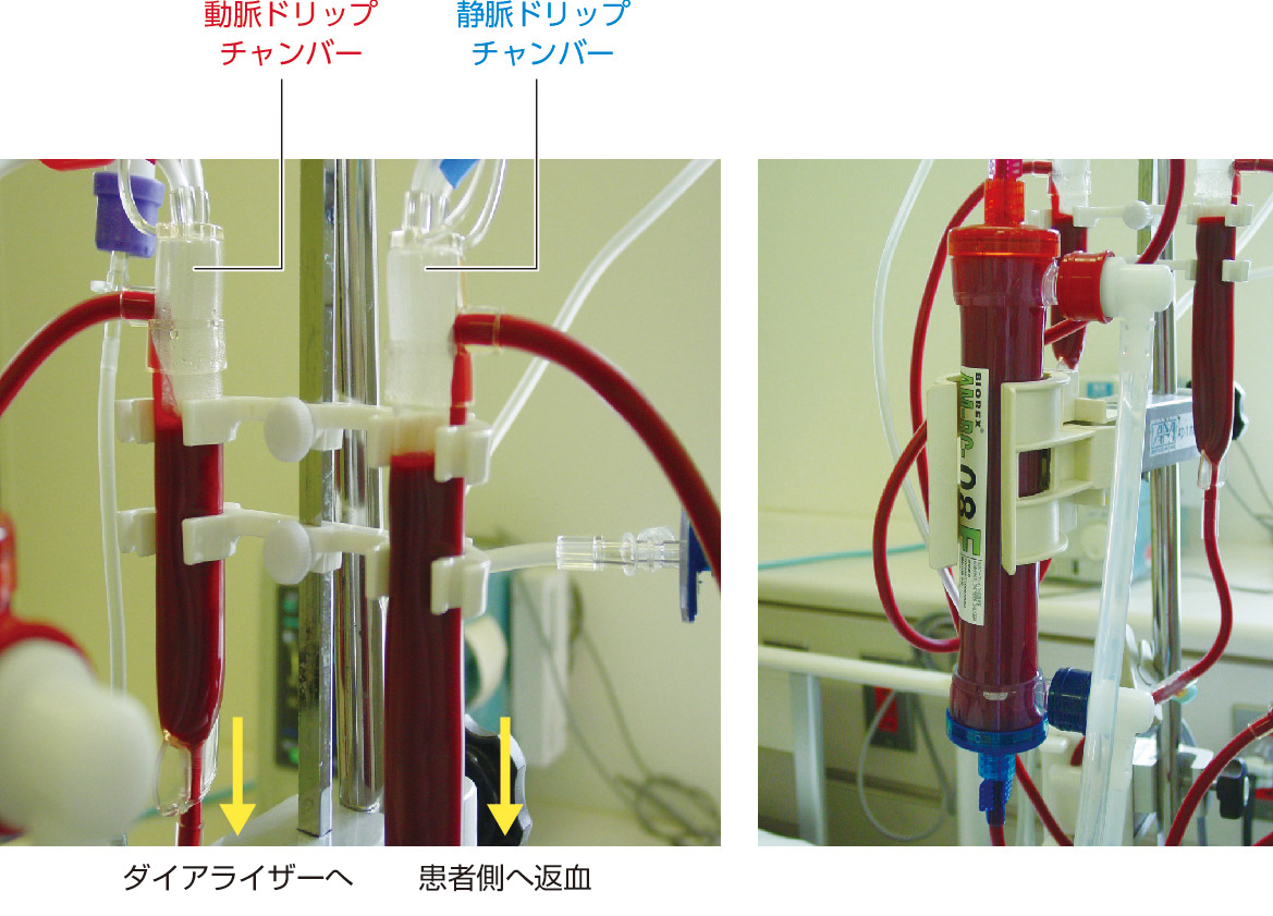 図4　透析回路 (チャンバー)． 