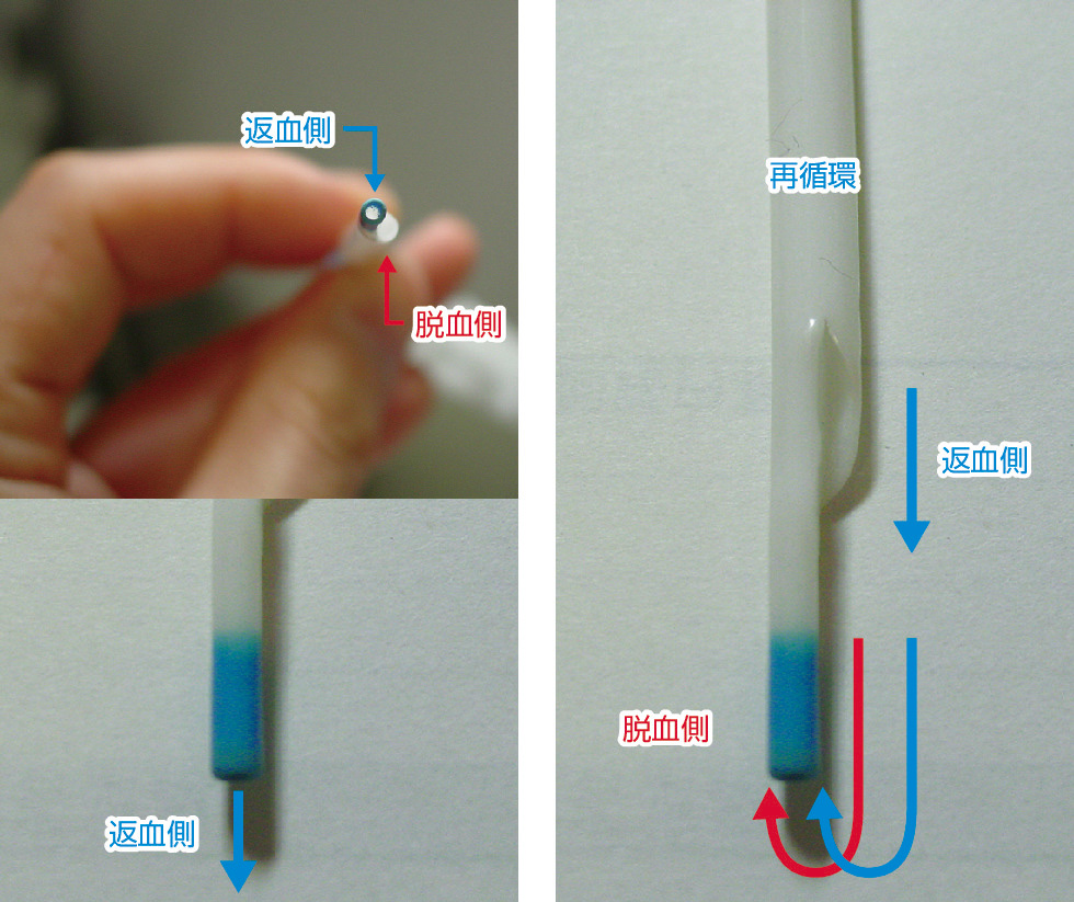図9　ブラッドアクセスカテーテル再循環． 