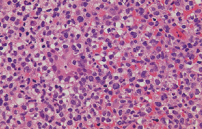 図1　リンパ腫様胃腸症 (竹内病) の胃生検像． NK細胞がシート状に増生しており，壊死像はみられない．