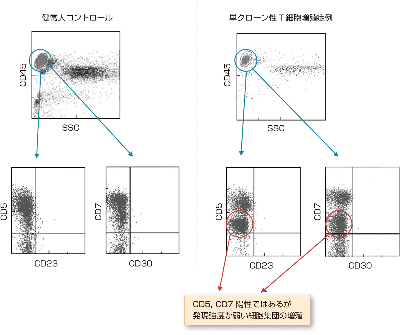 図1　末梢血に単クローン性T細胞が増殖した症例 (川野宏樹，皆川健太郎，他：臨床血液，2012; 53: 785–787)． 