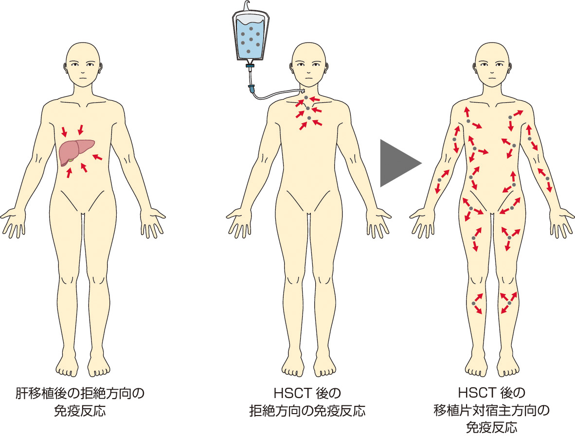 図1　HSCTと固形臓器移植での免疫反応の違い． 