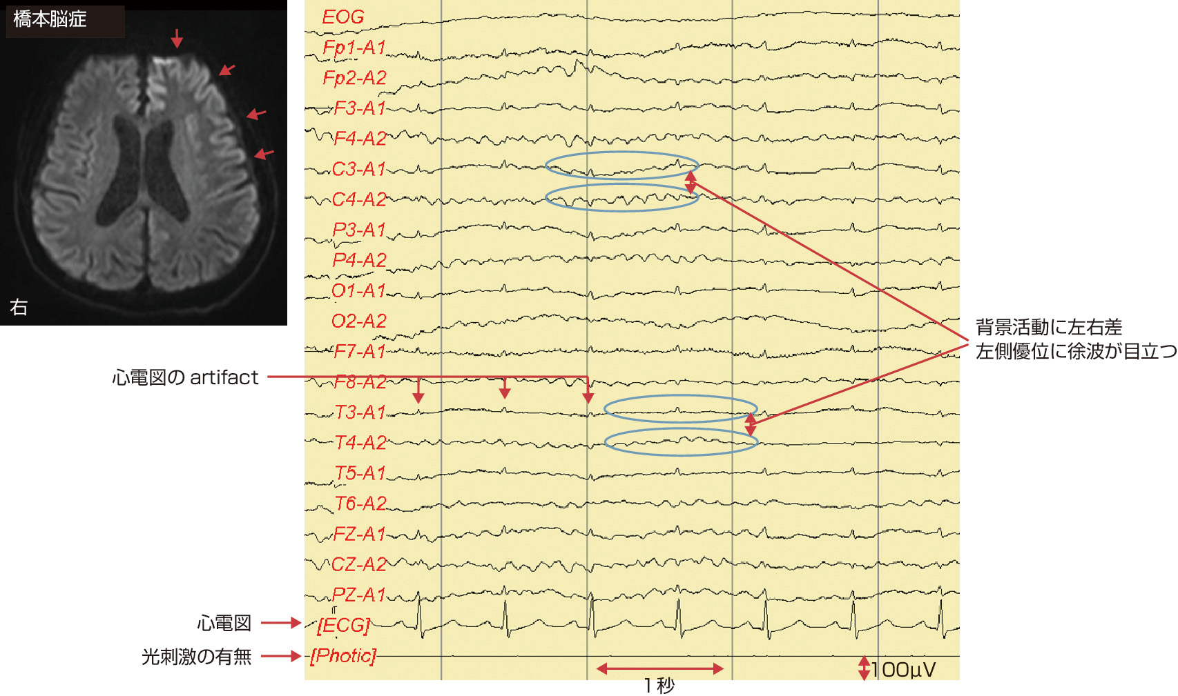 図1　脳MRI拡散強調画像と閉眼覚醒時の脳波． 51歳男性，橋本脳症の患者．脳MRI画像拡散強調画像では，左側の大脳皮質に前頭葉を中心に広く高信号領域を認めている (赤色矢印)．脳波では障害側である左半球の基礎波が右側に比較して徐波が目立つ．