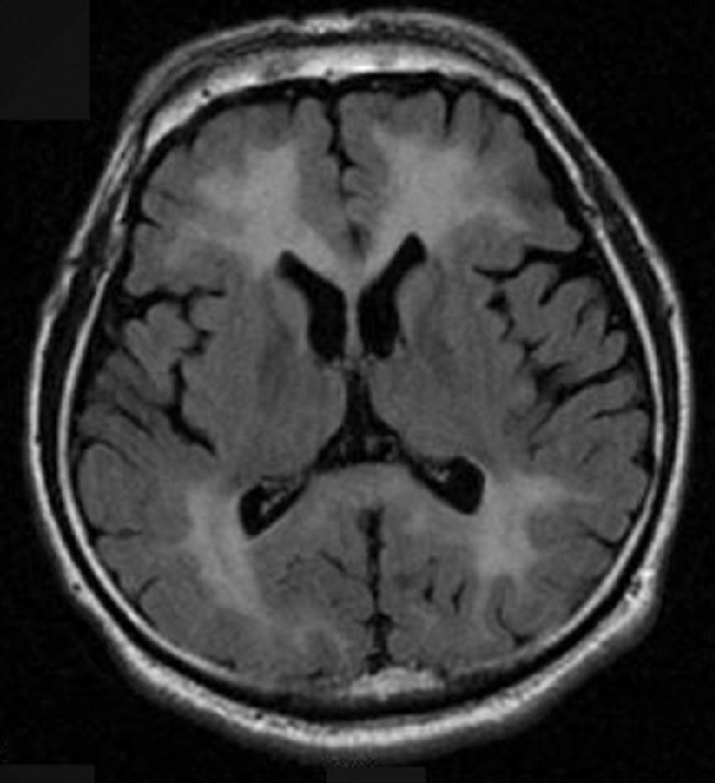 図2　CO中毒患者の遅発性脳症のMRI (FLAIR画像)． 脳室周囲の大脳白質および半卵円中心に両側・びまん性・合流性の高信号域を認める．