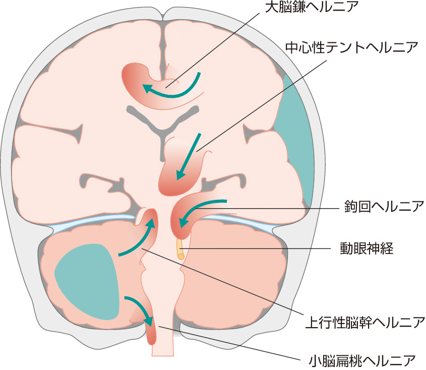 図4　脳ヘルニア． 