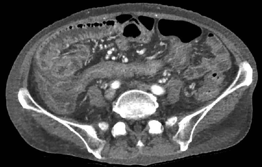 図1　腹部造影CT． 小腸の浮腫を認める．