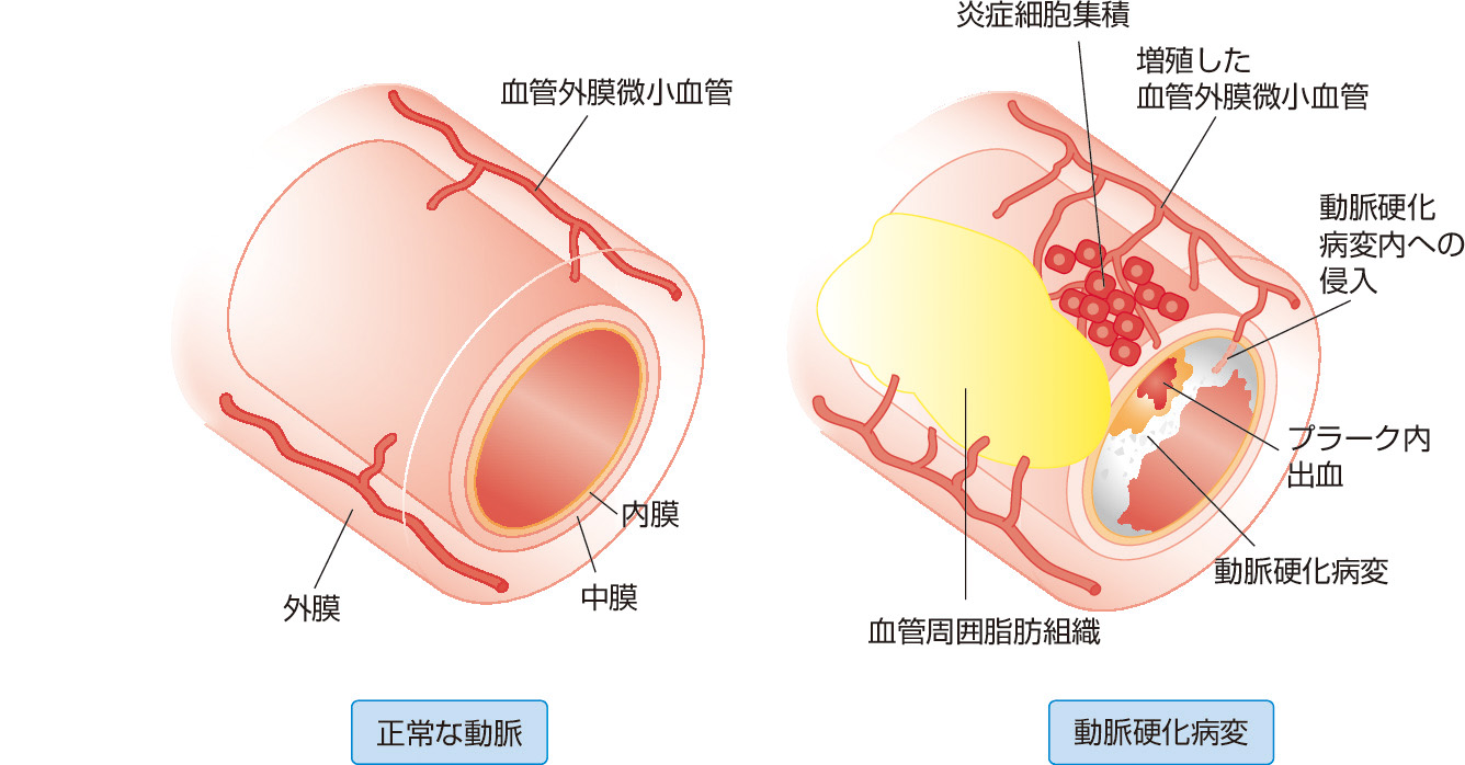 図1　動脈硬化病変と血管外膜微小血管． 正常な動脈では血管外膜微小血管は血管中膜の外側の栄養血管として機能する．動脈硬化病変では外膜微小血管は増殖して動脈硬化病変内に侵入し，病変内と外膜側とを交通する導管となるほか，プラーク内出血を生じ病変を不安定化させる．