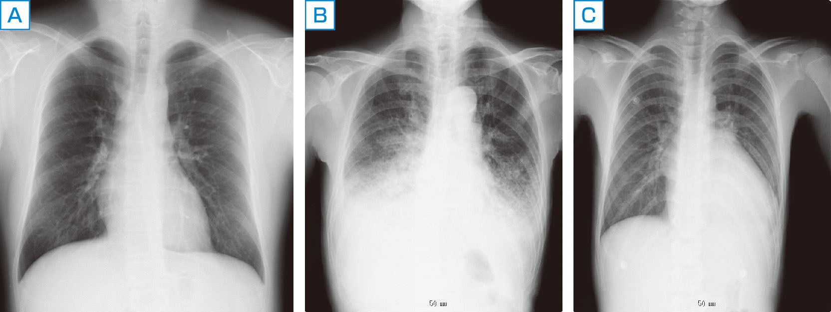 図1　健常者，急性増悪をきたした慢性心不全患者の胸部X線写真． A：健常者，B：HFpEF，C：HFrEFの急性増悪慢性心不全患者．