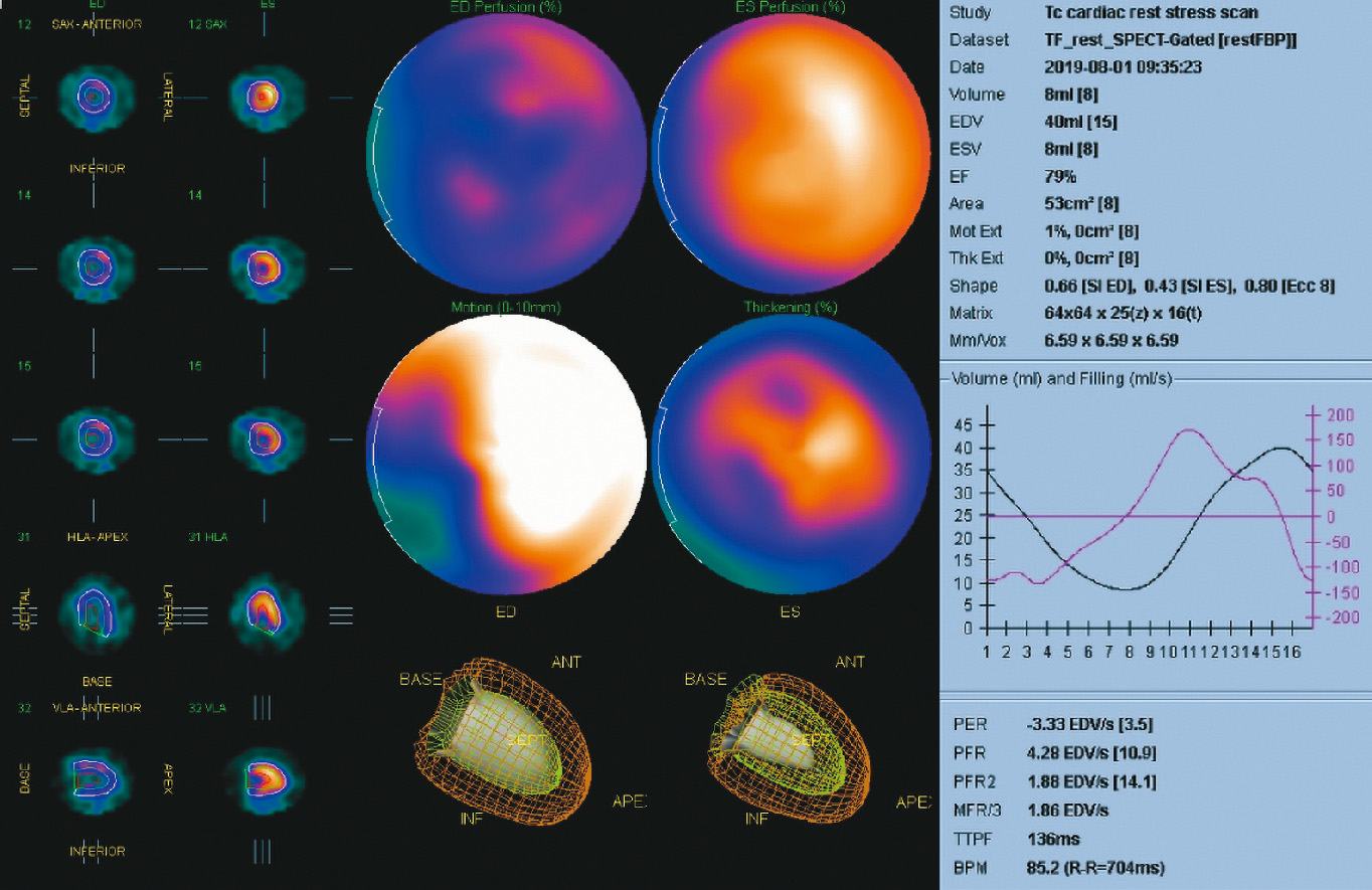図1　代表的なQGS画像<br>16分割心電図同期で撮像された心筋SPECT像がソフトウェア上で動き，壁運動評価ができる．また，同時に自動解析され，各種パラメータが算出される．黒線が1心拍の左室容積変化を示し，紫線が左室容積変化を時間微分して容積が変化する速度(dV/dt)を示す．<br>PER：最大駆出速度，PFR：最大充満速度，PFR2：第2相の最大充満速度，MFR/3：早期平均充満速度(1/3MFR)，TTPF：最大拡張到達時間(TPFR)，BPM：心拍数．