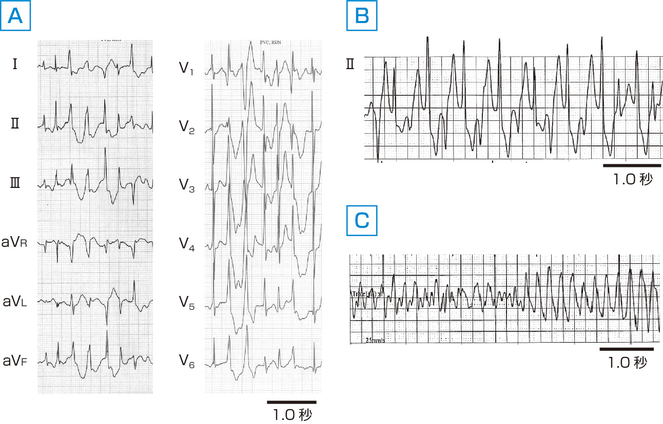 図2　カテコールアミン誘発性多形性心室頻拍． A：運動負荷中に認められた心室頻拍．数種類のQRSが観察される． B：Aの後に認められた2方向性心室頻拍．2種類のQRSが交互に出現する特徴的な心室頻拍である． C：2方向性心室頻拍後に発生した心室細動．カテコールアミン誘発性多形性心室頻拍はこのような心室細動により突然死に至る危険性が高い．