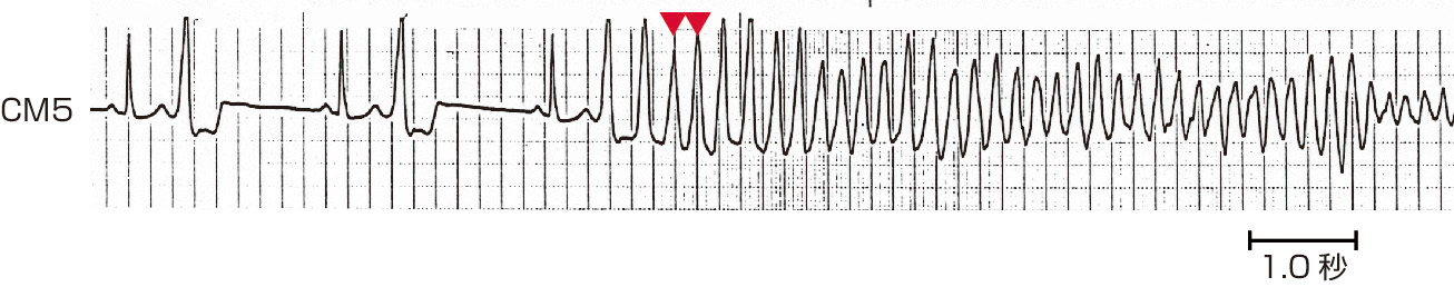 図2　特発性右室流出路起源心室頻拍から発生した心室細動． レートが240拍/分以上で，QRS波形が変貌する (赤色の▼印) 所見が心室細動以降のリスクとされている．