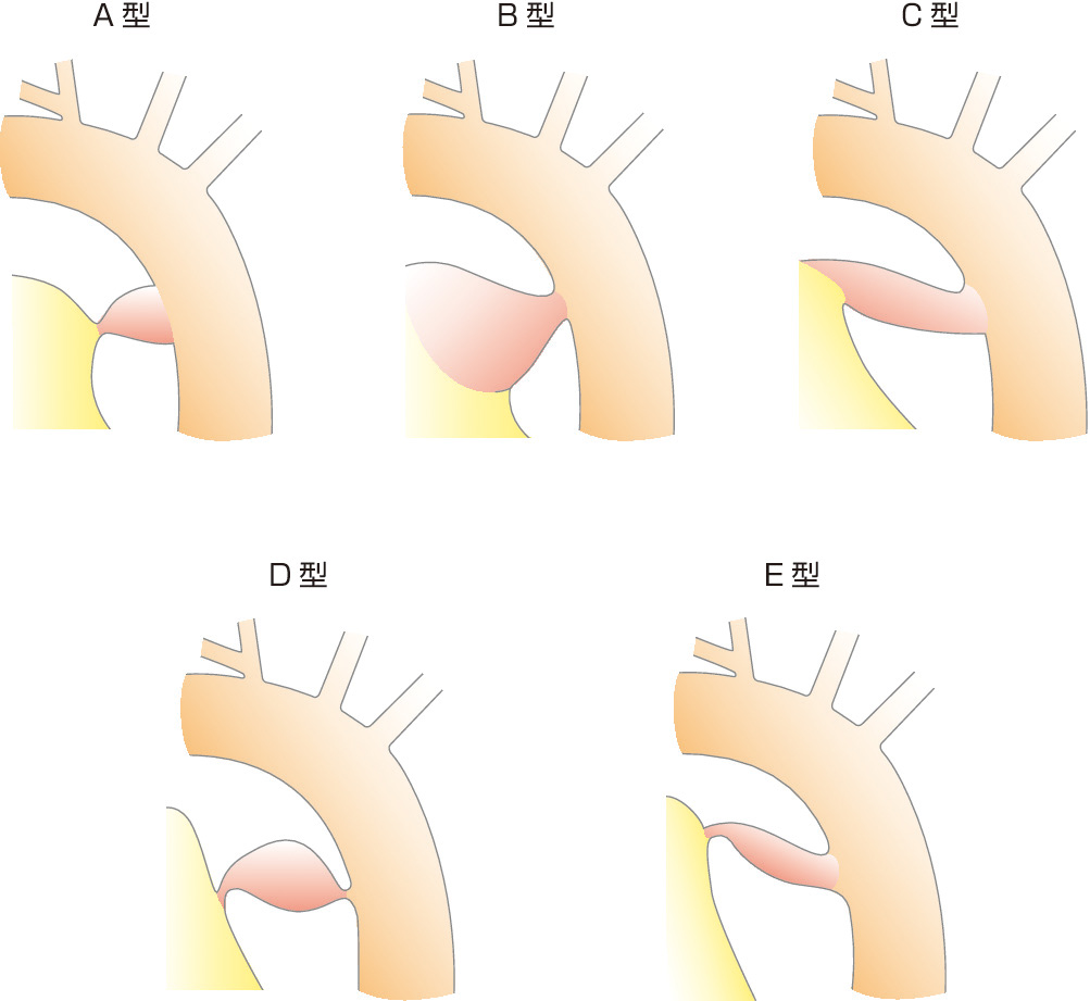 図1　Krichenko分類． A型 (円錐型)：最小部が肺動脈側，膨大部が大動脈側．B型 (窓型)：最小部が大動脈側，動脈管径が短小．C型 (管型)：最小部のない管型．D型 (動脈瘤型)：最小部が複数箇所．E型 (伸展円錐型)：細長い管型，最小部が気管より前方．
