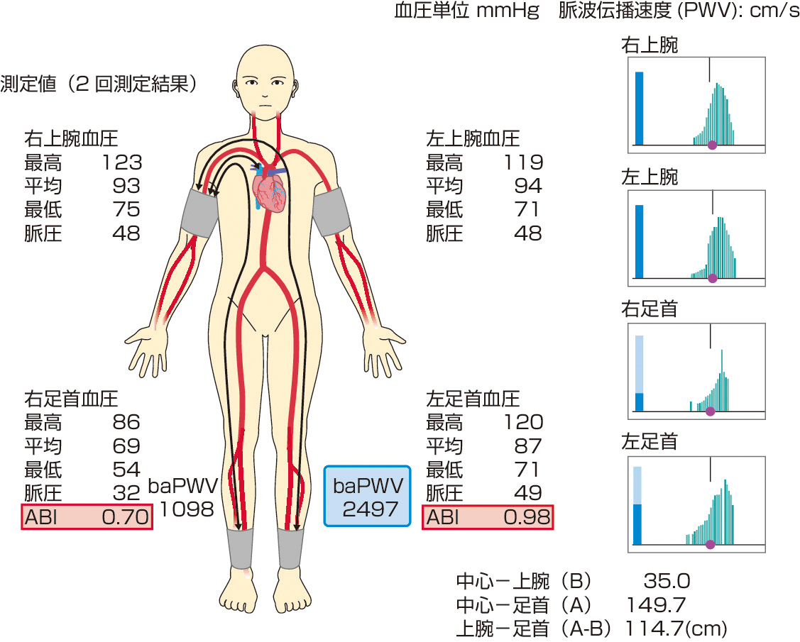 図2　ABIの結果． 右下肢ABIが0.70と0.90以下であることから，この患者は右下肢の閉塞性動脈硬化症が疑われる．
