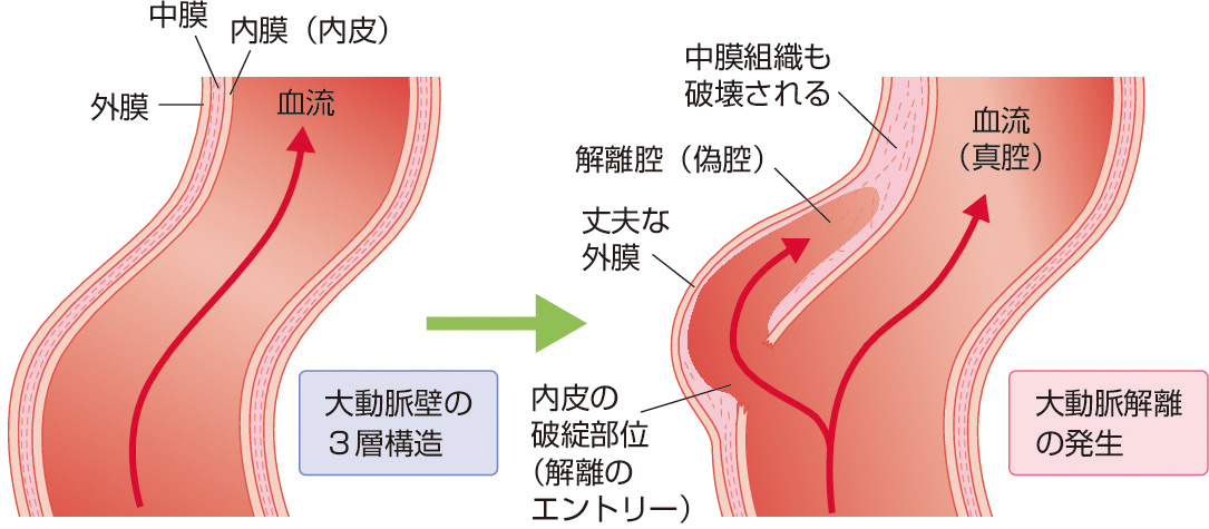 図1　大動脈瘤や大動脈解離の発症メカニズム． 