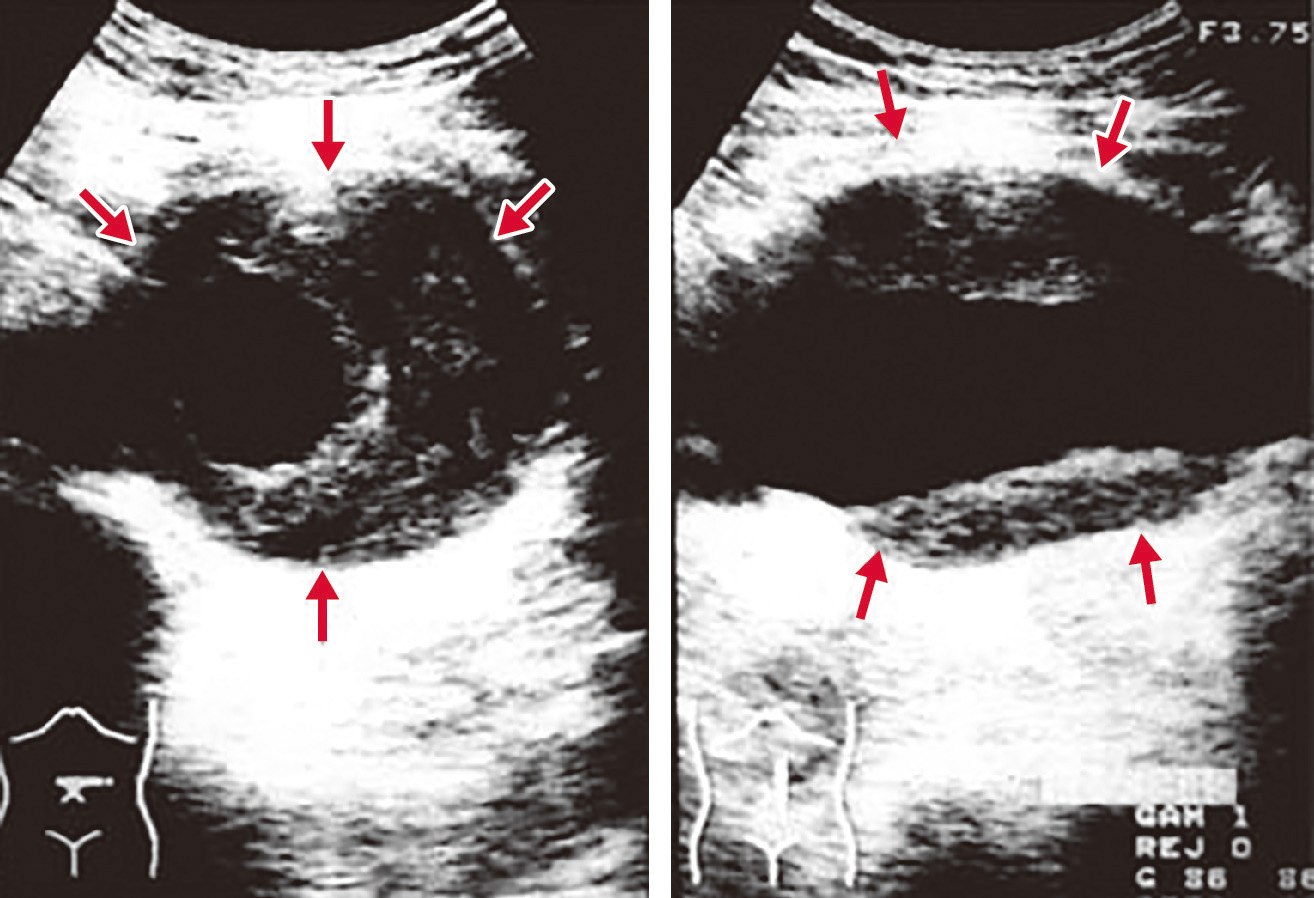 図2　大動脈瘤の腹部超音波像． 左図は腹部大動脈瘤の部位を短軸プローブ走査したもの，右図は同部位を長軸プローブ走査したものである．左図の短軸像では，時計10時方向から8時方向にかけて三日月状プラークを認め，腹部大動脈はこの部位で瘤状に拡大している．内腔が狭小化するにつれて血管が外膜方向に拡張する代償機転すなわち「血管リモデリング」が起きている．右図の長軸像では，プローブ近位と遠位にプラークを認め，やはり同部位で「血管リモデリング」が起きているのがわかる．