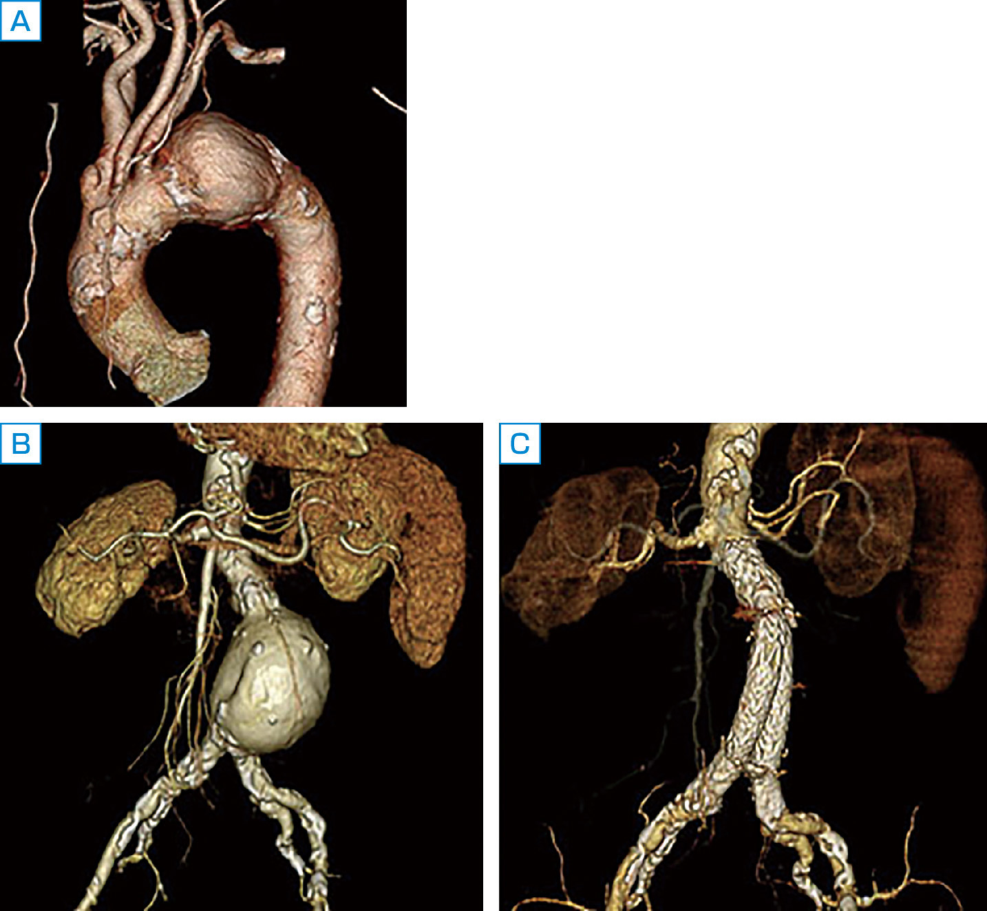 図3　大動脈瘤の造影CT像． Aでは造影CTで右腕頭動脈ならびに左総頸動脈と左鎖骨下動脈を分岐した後の大動脈弓部に大動脈瘤を認める．近年は大動脈内ステント術も行われるようになってきた．Bでは，左右の腎動脈分岐部より末梢で左右大腿動脈分岐部より中枢に腹部大動脈瘤を認める．これに対して大動脈内ステント術を行ったのがCである．