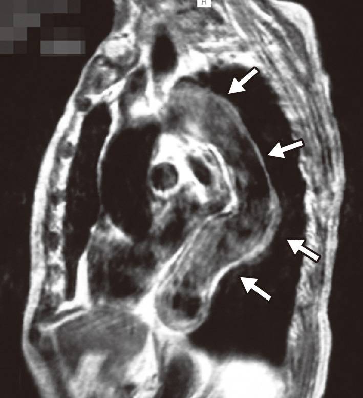 図4　大動脈疾患のMRI像． 図に示すように，胸部下行大動脈は蛇行しながら拡張している．胸部大動脈瘤では瘤を含む血管径50 mm以上，腹部大動脈瘤では瘤を含む血管径40 mm以上で，破裂のリスクが高いとされる．