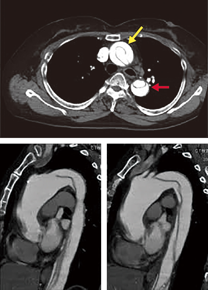 図6　大動脈解離の造影CT像． 胸部造影CT横断像で，上行大動脈と下行大動脈にひも状のflapを認め，真腔も偽腔も同じように造影剤で満たされている．解離が上行大動脈から下行大動脈と広範囲に及ぶA型解離である．