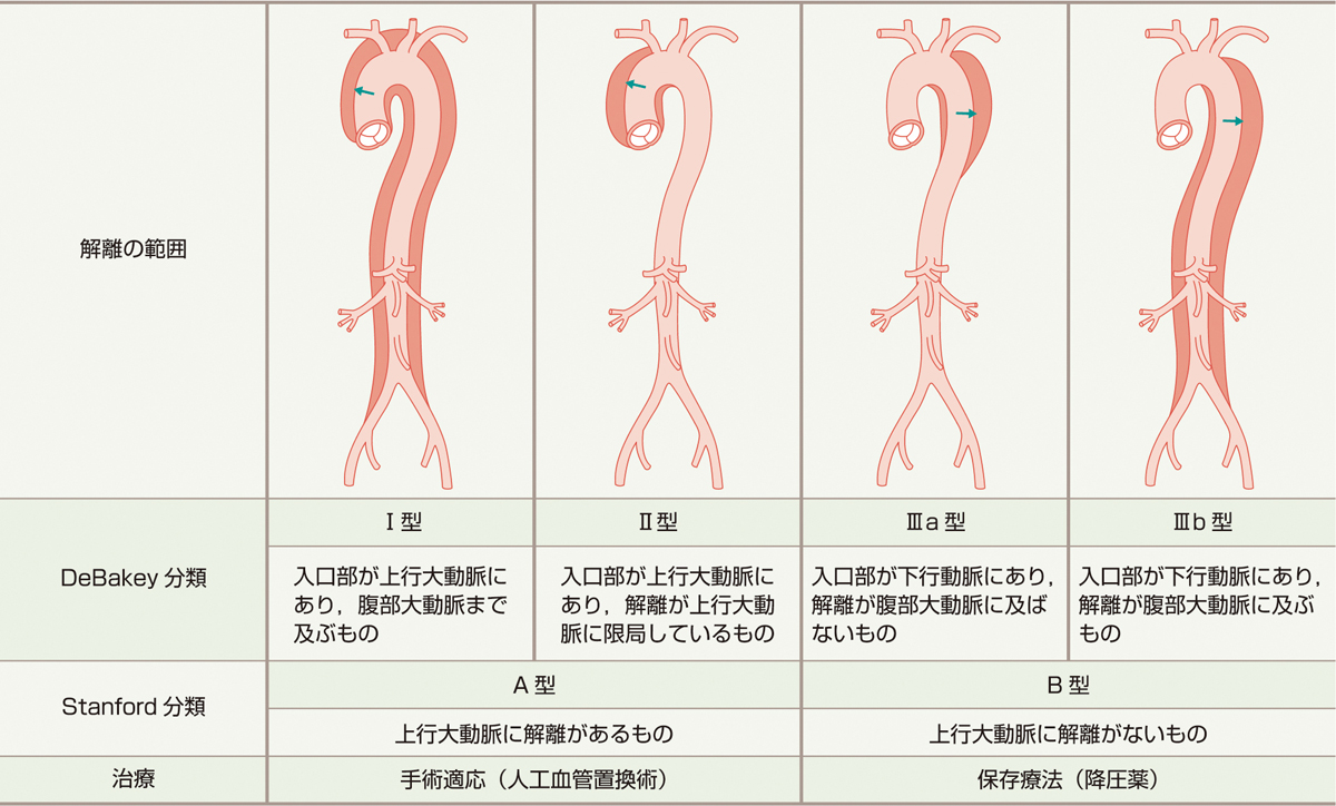 表1　胸部大動脈解離分類． 