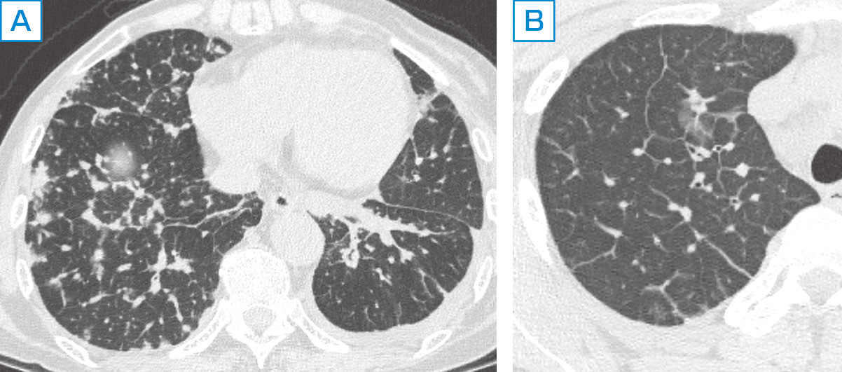 ⓔ図10-1-11　癌性リンパ管症 (A) と肺水腫 (B) のCT画像 A：不整あるいは結節状の小葉間隔壁の肥厚が数珠状に見える． B：小葉間隔壁が平滑な肥厚を呈しているのがわかる．