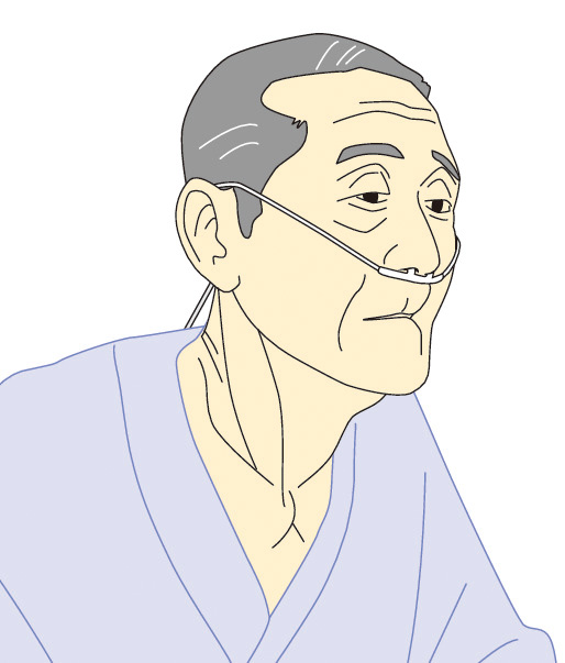 ⓔ図10-1-2　慢性閉塞性肺疾患での胸鎖乳突筋の発達と口すぼめ呼吸 