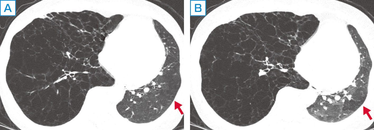 ⓔ図10-1-5　左片肺移植後のair trapping像 肺リンパ脈管筋腫症に対して，左片肺移植をした症例である．吸気CT (A) に比して，呼気CT (B) にてair trapping像が明瞭化しているのがわかる (矢印)．