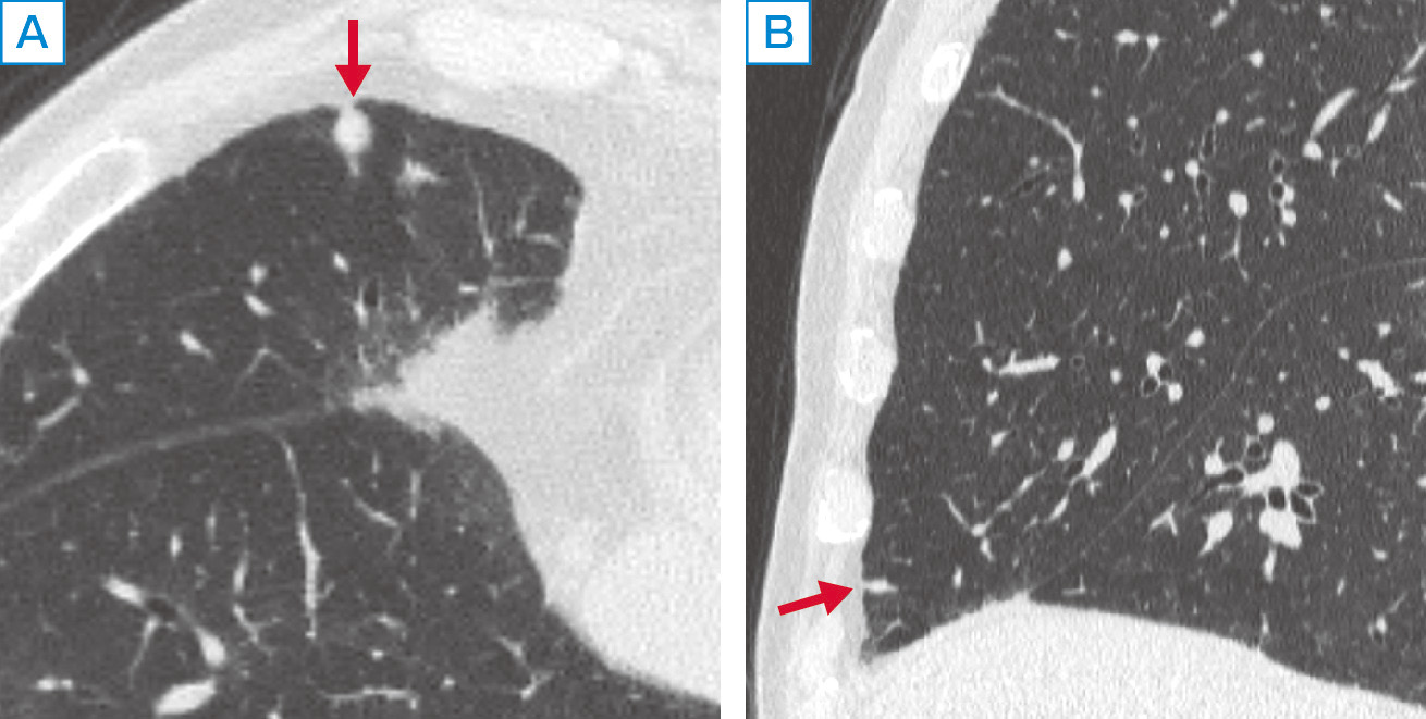 ⓔ図10-1-7　小さな肺結節のMPR画像 A：はCT横断像．右肺中葉に径5 mm大の円形の結節を認める (矢印)． B：CT矢状断像．同結節は扁平な形態であるのがわかる (矢印)． 本症例の横断像ではサイズが小さく質的診断は難しいが，矢状断像から炎症性結節や肺内リンパ節のような良性結節の可能性が高まる．
