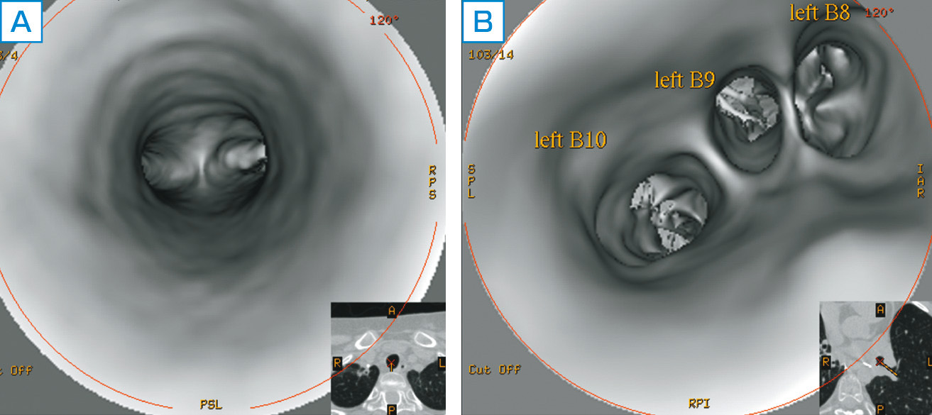 ⓔ図10-1-8　仮想気管支内視鏡 CT画像から簡単に気管支内視鏡のような画像を作成できる．このような仮想内視鏡を用いれば，CT画像を基に病変部への経路を術前にシミュレーションすることが可能である．