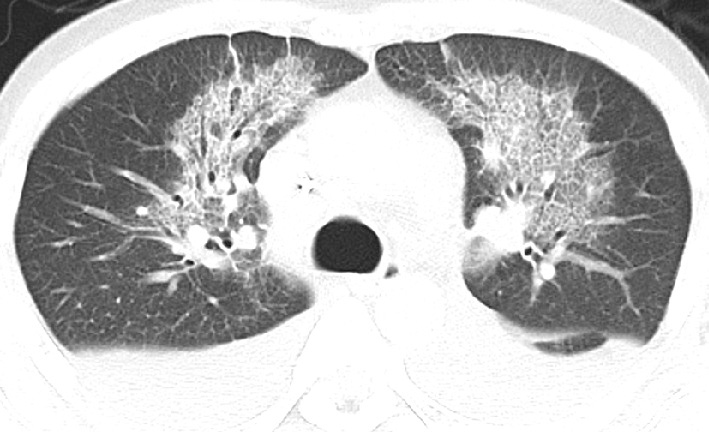 ⓔ図10-1-9　肺水腫のCT画像 典型例では陰影は肺門側優位に分布を示し，末梢肺がスペアされることが多い．また，陰影は荷重部優位に分布して認められることが多いのも特徴である．すりガラス影に重なって小葉間隔壁の肥厚を認め，小葉内網状影を呈している．いわゆる，crazy–paving appearance (メロンの皮様所見) である．