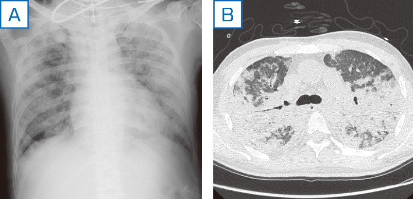 ⓔ図10-10-6　症例3：非心原性肺水腫 (ARDS) A：胸部X線写真．両肺にびまん性のすりガラス様陰影～浸潤影を認める． B：胸部CT．両肺に広範な浸潤影と気管支透亮像を認める．