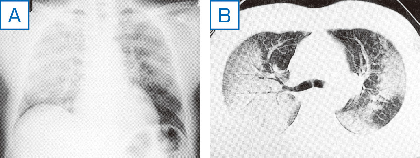 ⓔ図10-10-7　症例4：非心原性肺水腫 (ARDS) A：胸部X線写真．両肺にびまん性のすりガラス様陰影～浸潤影を認める． B：胸部CT．両肺にびまん性のすりガラス様陰影～浸潤影と気管支透亮像を認める．