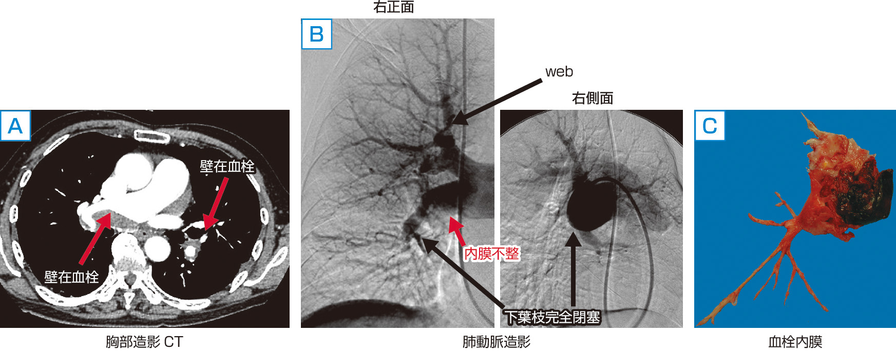 ⓔ図10-10-8　慢性血栓塞栓性肺高血圧症 (画像所見と摘出された血栓内膜) (千葉大学医学部呼吸器内科 杉浦寿彦先生，同大学心臓血管外科 石田敬一先生のご厚意による) A：右肺動脈本幹，左肺下葉動脈に壁在血栓 (矢印) を認める． B：肺動脈造影 (右正面，側面) では，下葉枝完全閉塞所見，web (篩状の欠損)，内膜不整を認める． C：内膜とともに血管の鋳型状の血栓が摘出され，平均肺動脈圧は35 mmHgから15 mmHgに低下した．