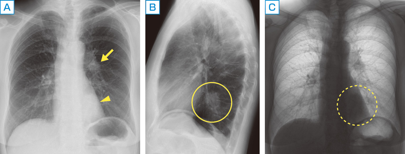 ⓔ図10-12-1　肺腺癌症例の胸部X線像 A：正面像では心陰影に重なって原発巣 (矢頭) の確認が難しい．左肺門部リンパ節腫大 (矢印) が確認される． B：側面像では心臓背側の原発巣が鮮明に確認できる． C：正面像を白黒反転させると原発巣が確認しやすくなる．