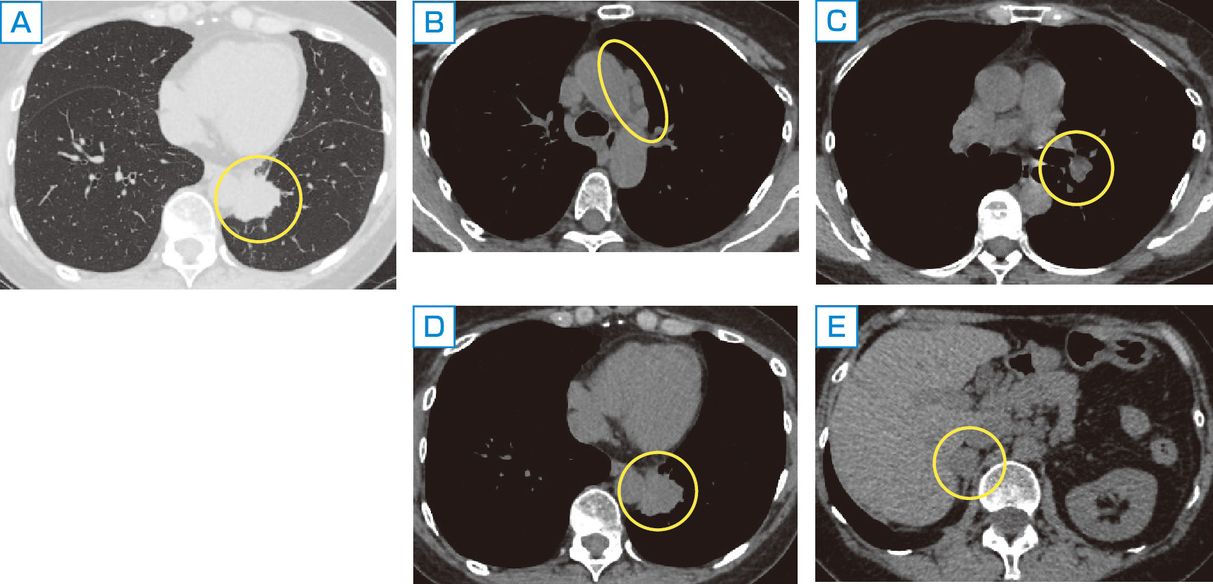 ⓔ図10-12-2　ⓔ図10-12-1と同一症例の胸部CT像 A：肺野条件における下行大動脈に接する原発巣．以下縦隔条件におけるCT像． B：大動脈弓部外側の縦隔リンパ節転移． C：左肺門部リンパ節転移． D：原発巣． E：右副腎転移．