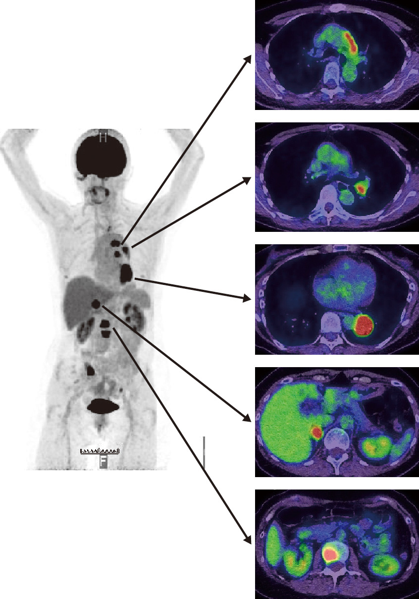 ⓔ図10-12-3　ⓔ図10-12-1と同一症例のPET–CT像 上から大動脈弓部外側のリンパ節転移，左肺門部リンパ節転移，原発巣，右副腎転移，胸椎転移への高度なFDG集積を認める．