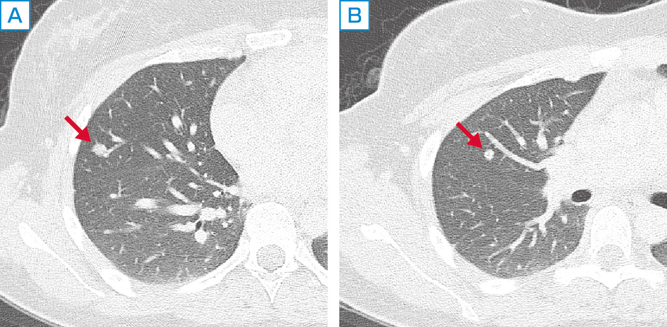 ⓔ図10-12-4　卵巣癌多発肺転移 (19歳女性) 