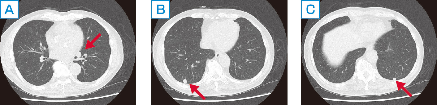 ⓔ図10-12-5　腎臓癌多発肺転移 (86歳男性) 