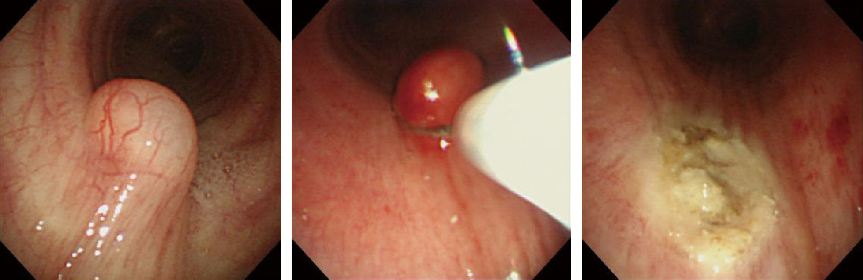 ⓔ図10-12-7　気管支鏡下スネア焼灼術で切除した気管内過誤腫 