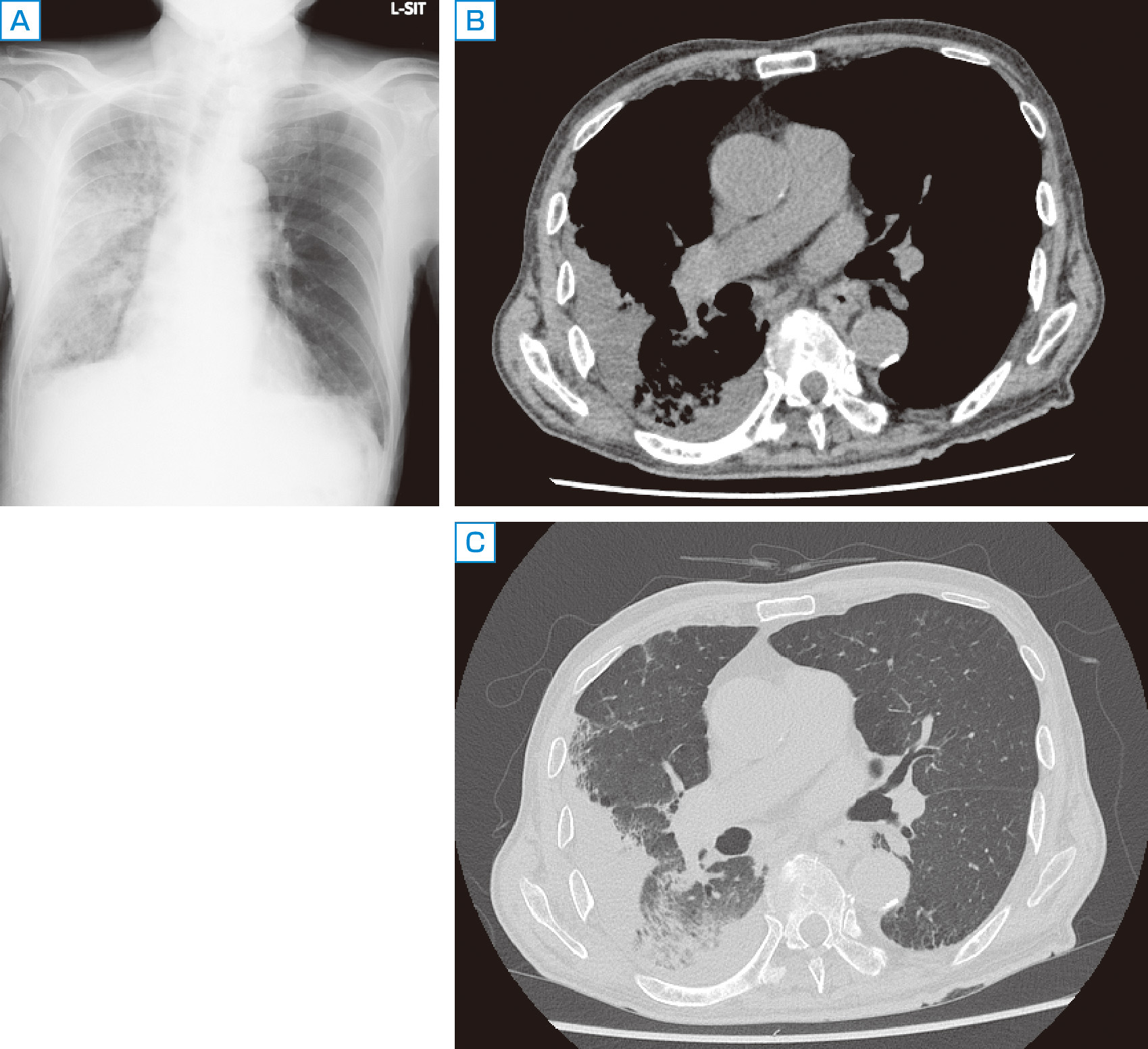 ⓔ図10-14-1　肺炎随伴胸水 (73歳男性) (新潟大学医歯学総合病院・青木信将先生ご提供) 