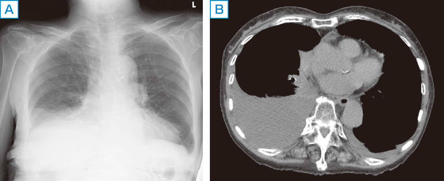 ⓔ図10-14-3　原発性滲出性リンパ腫 (79歳女性) (新潟大学医歯学総合病院・青木信将先生ご提供) 