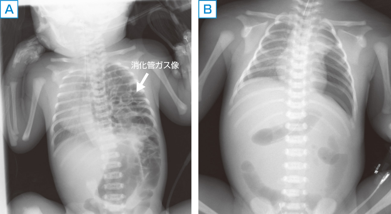 ⓔ図10-16-1　左横隔膜へルニア (Bochdalek孔ヘルニア) の例 (鳥取大学医学部附属病院NICU病棟医長・三浦真澄博士より提供) A：出生後の胸部単純X線写真．左胸腔に腸管の脱出による消化管ガス像を認める．左横隔膜ヘルニアに伴う左肺低形成のため肺高血圧症を合併していた． B：横隔膜ヘルニア修復術後の胸部単純X線写真．胸腔内の消化管ガス像を認めない．