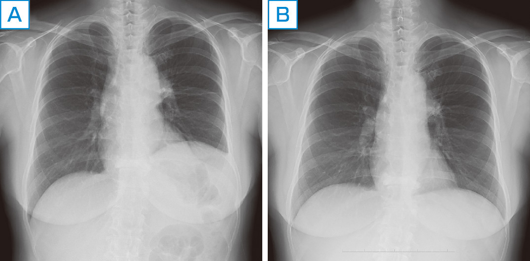ⓔ図10-16-3　横隔膜麻痺 (縦隔腫瘍) 胸部X線写真 57歳女性，左上葉肺腺癌．化学療法前 (A)，化学療法開始2カ月後 (B)
