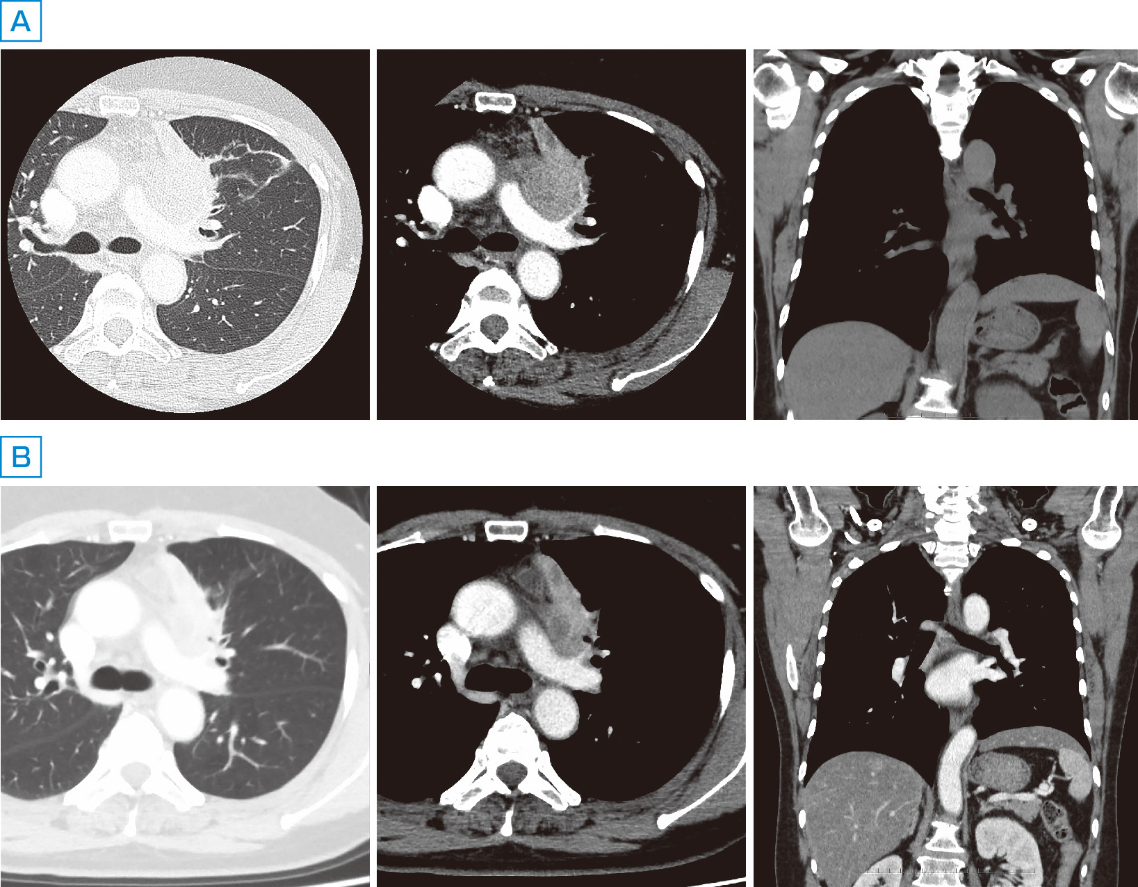 ⓔ図10-16-4　横隔膜麻痺 (縦隔腫瘍) 胸部CT画像 左上葉肺腺癌stageⅣB．化学療法開始前 (A)，化学療法開始2カ月後 (B)